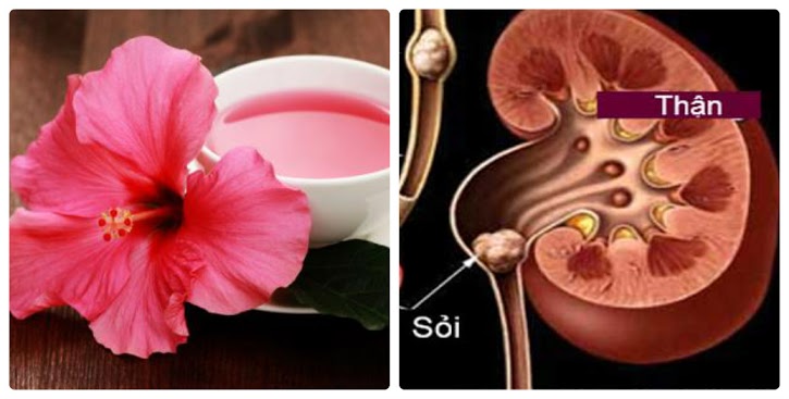 Chữa sỏi thận bằng hoa râm bụt cực kì hiệu quả